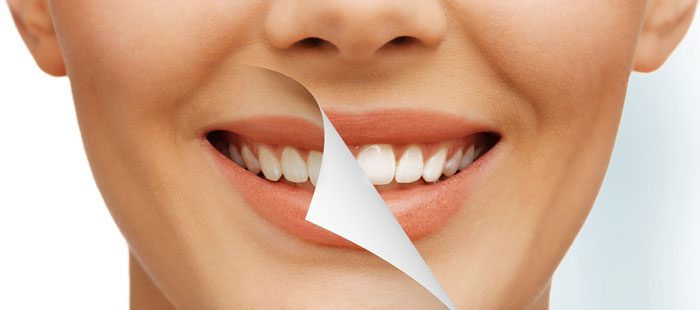 Teeth Whitening:  Is it safe?