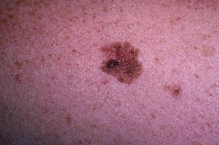 FDA approves new life-extending drug for the treatment of melanoma