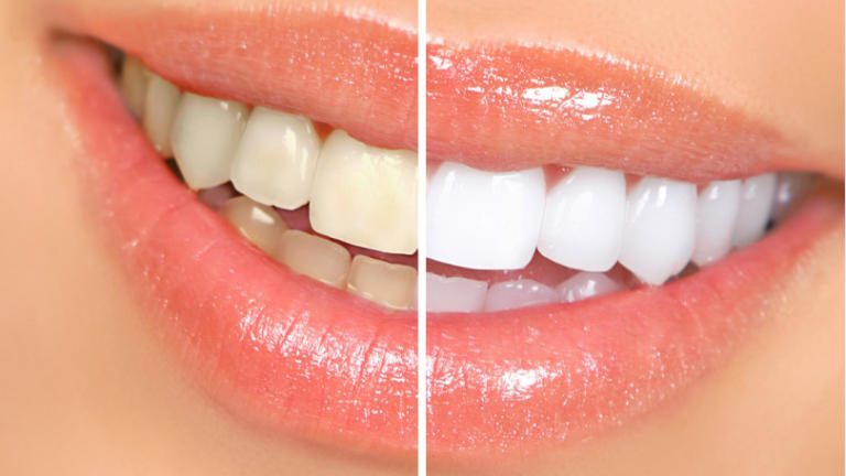 Free Teeth Whitening – The Costa Rica Dental Team