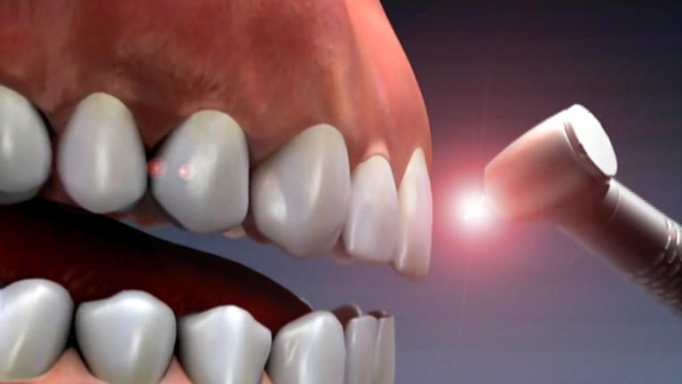 The Use of Laser in Dentistry