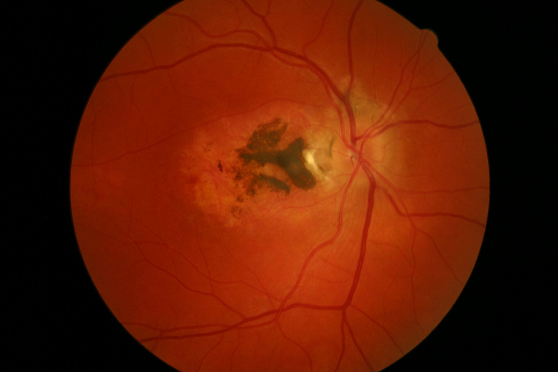 Roundworm In Eye Costa Rican Children are Contracting Eye Worms Due to Negligent Pet Owners