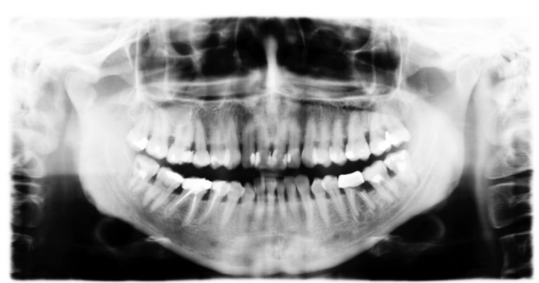 X-rays – First Step For a Successful Dental Experience