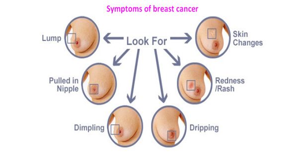 Symptoms of breast cancer.