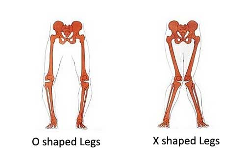 Leg deformities are common orthopedical issues.