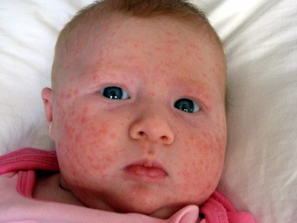 It can be a very serious affection for your baby's skin.