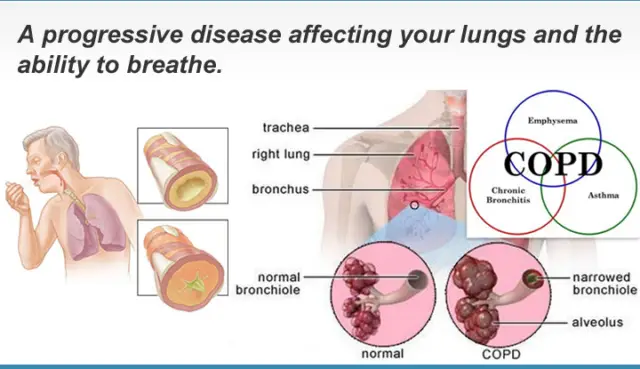 COPD is a very serious respiratory disease.