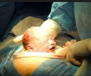 Cesarean