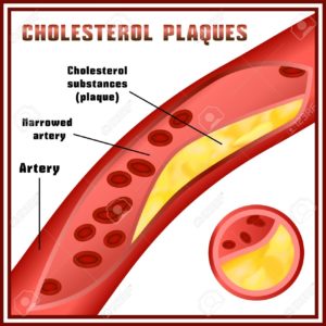 Cholesterol plaques are