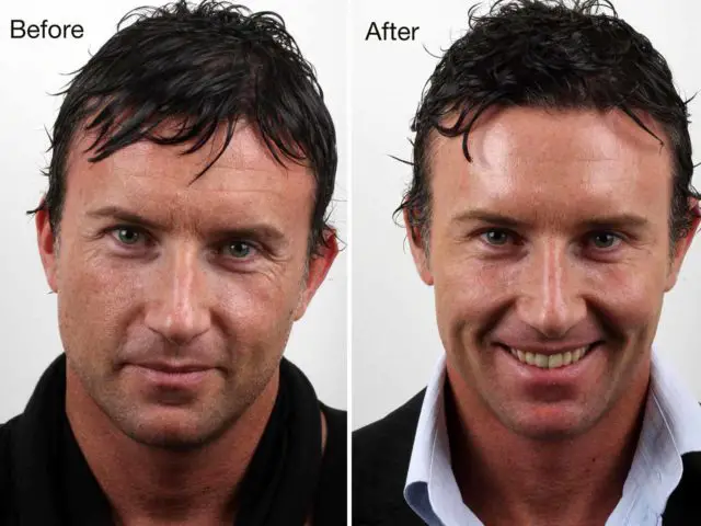 Rejuvenation treatment: before and after