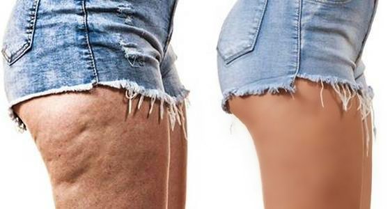 Cellulite legs vs soft peach skin legs