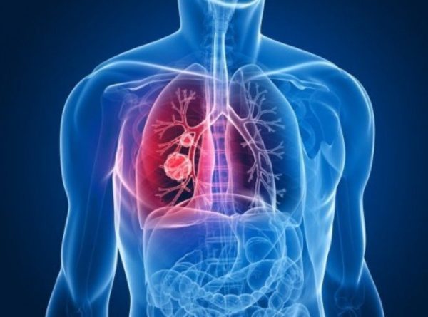 Tuberculosis: An Illness that Still Causes Havoc around the World ⋆ The ...