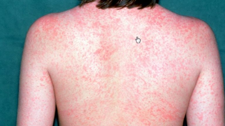 Inciensa Confirms 2 New Imported Cases of Measles for Children of American Origin
