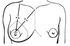 The Problem Of Breast Asymmetry After An Operation