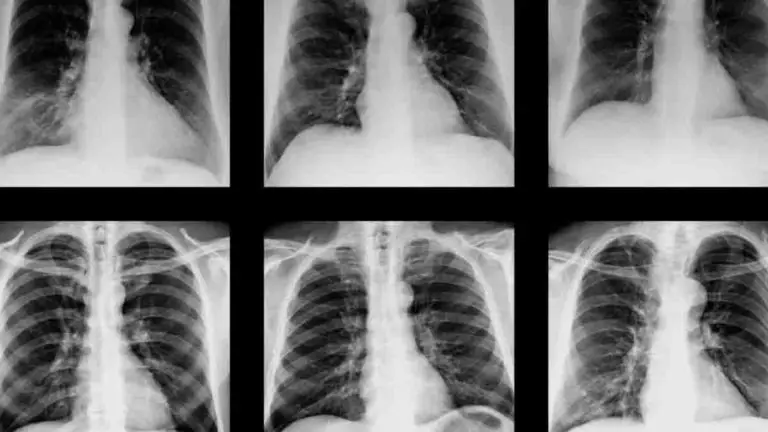 Artificial Intelligence Could Facilitate the Use of Chest X-rays to Diagnose COVID-19