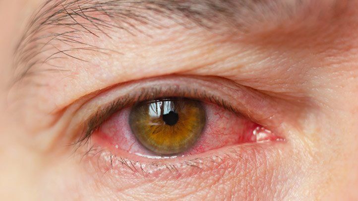 Dryness of the Cornea and Red Eyes are Frequent Evils with the Arrival of Telework