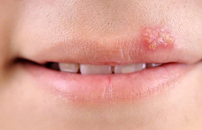 Everything You Need to Know About Cold Sores