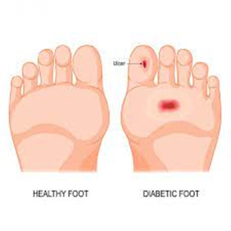 Be Careful with Diabetic Feet! ⋆ The Costa Rica News