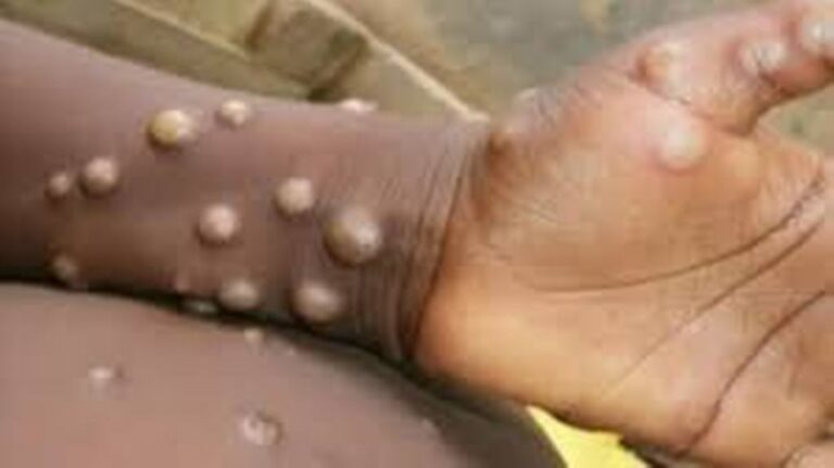 Monkeypox and Human Smallpox: These Are the Similarities and Differences between Them
