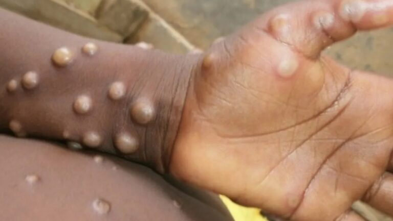 Costa Rica Remains On Alert for Possible Appearance of Monkeypox