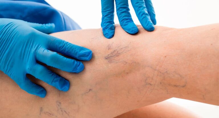 How to Eliminate Varicose Veins without Surgery