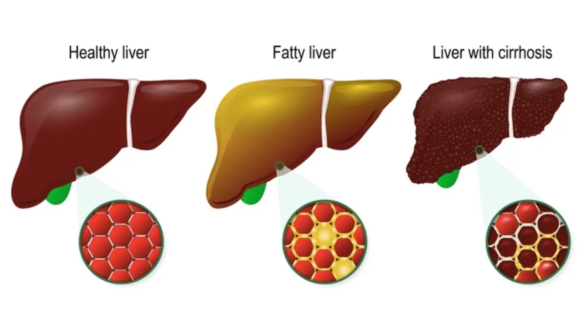 40% of People Who Are Left Untreated for Fatty Liver Problems