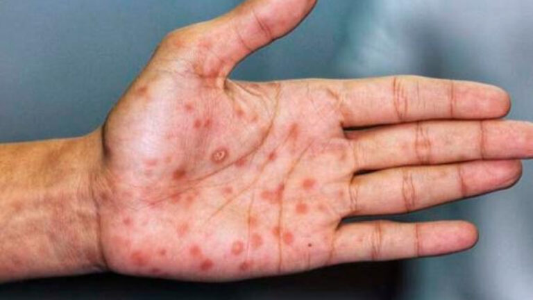 World Health Organization Investigates Whether Rapid Spread of Monkeypox is Due to Mutations