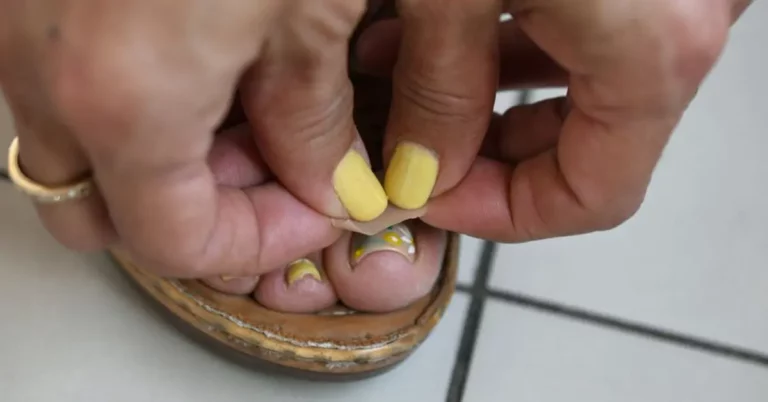 UCR Students Create Patches to Remove Nail Fungus