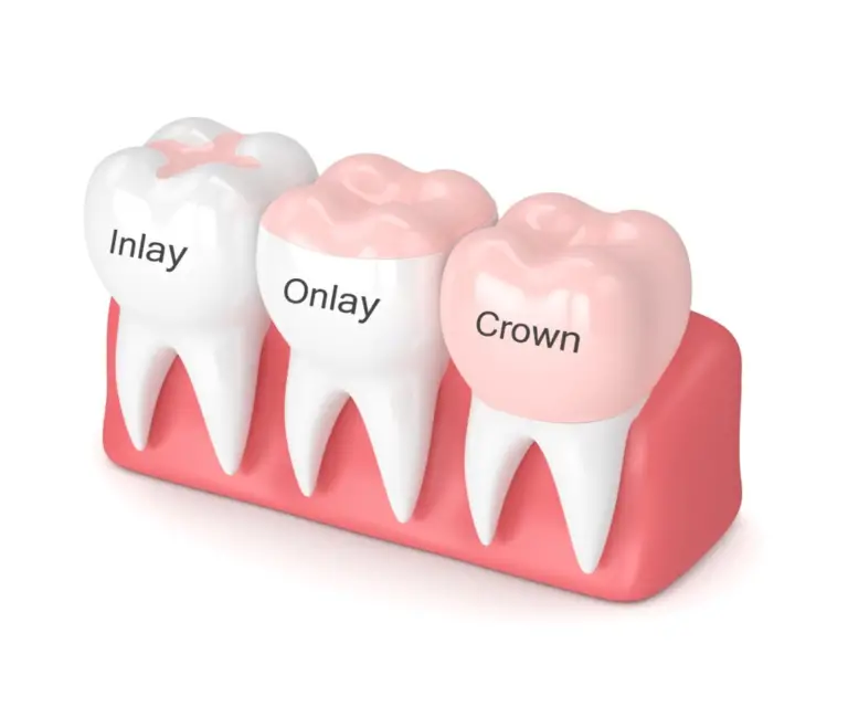 Why Do I Need A Dental Crown?