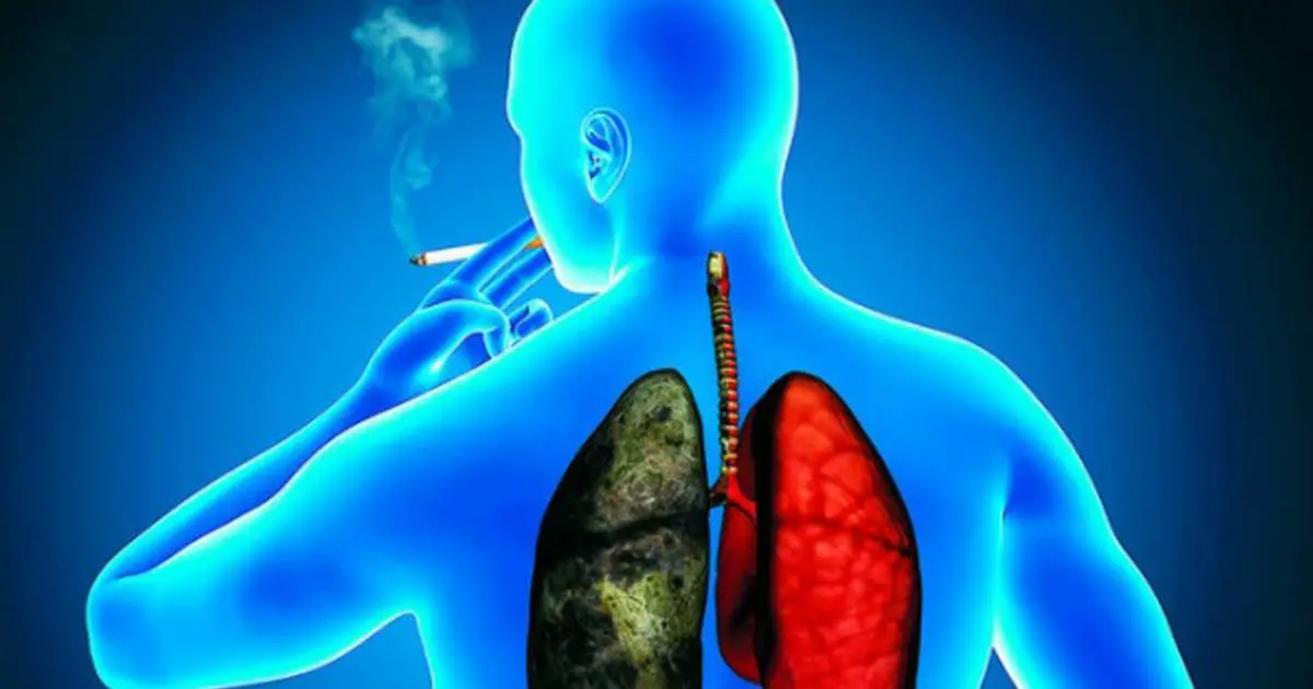 Research Will Identify Needs and Barriers of Lung Cancer...