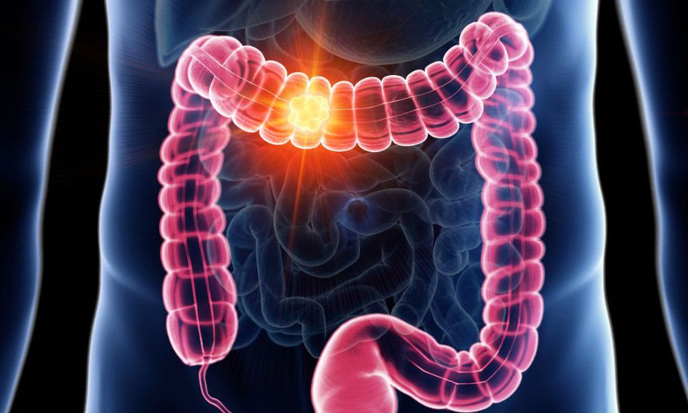 Colon Cancer Is the Second Most Frequent Type of Cancer in Costa Rica