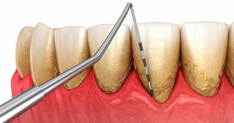 People with Periodontitis May Have Twice the Risk of Alzheimer’s and Triple the Risk of Suffering an Ischemic Stroke
