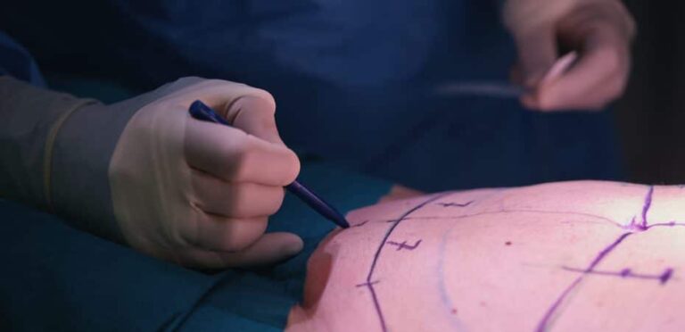 Liposuction and Liposculpture Are Prohibited as Treatment for Overweight and Obesity in Costa Rica