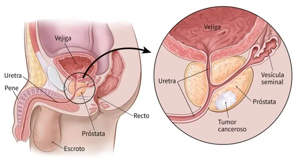 Prostate Cancer Becomes a Silent Threat That Claims More than 460 Lives a Year in Costa Rica